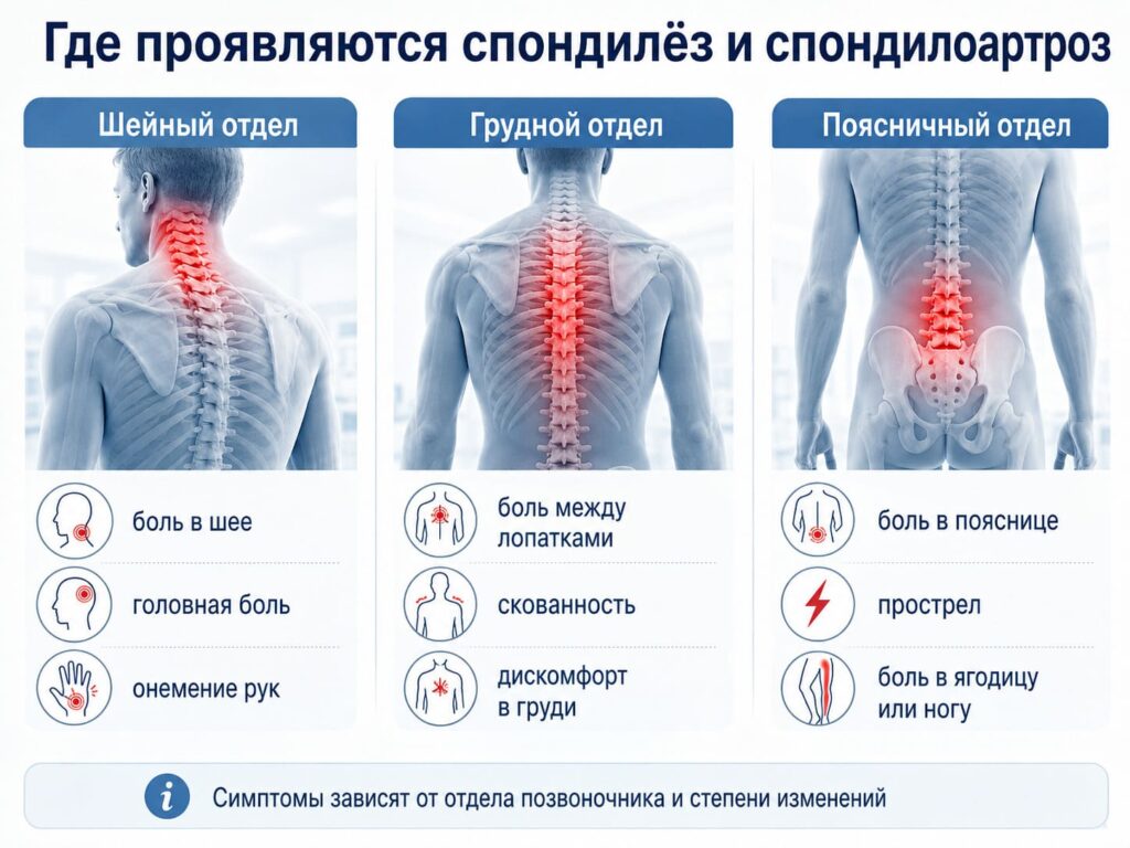 Симптомы спондилёза и спондилоартроза шейного, грудного и поясничного отделов позвоночника